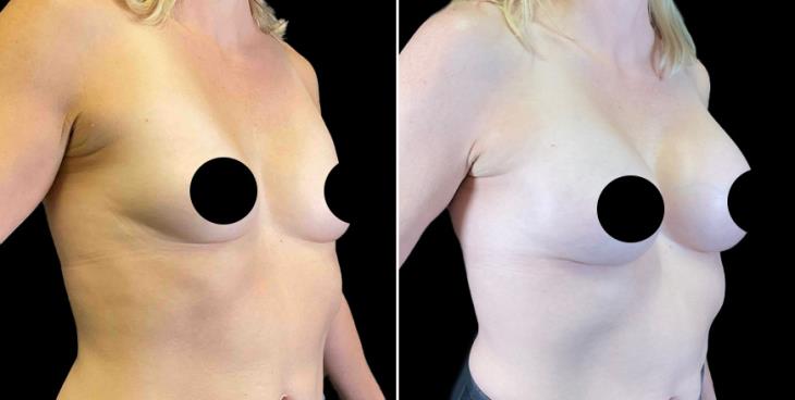 ¾ View Saline Breast Implants