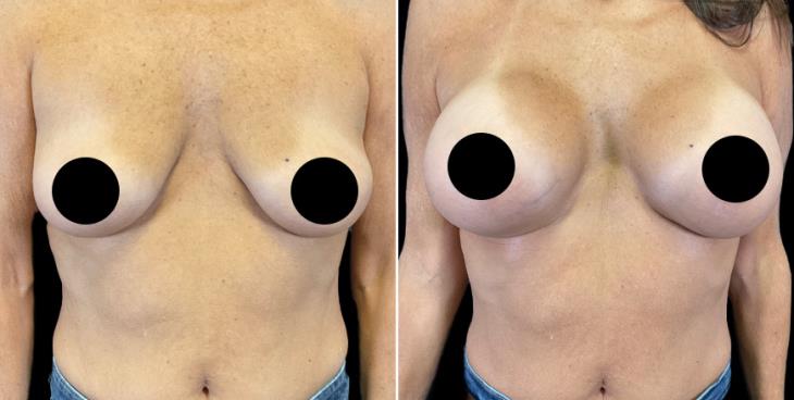 Full Profile Breast Implants