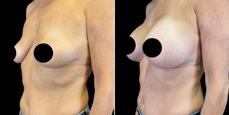Full Profile Breast Implants ¾ View