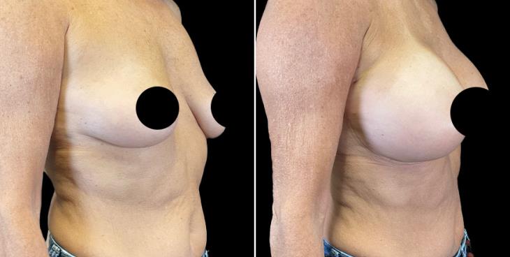 ¾ View Full Profile Breast Implants