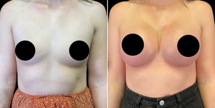 Full Profile Breast Augmentation