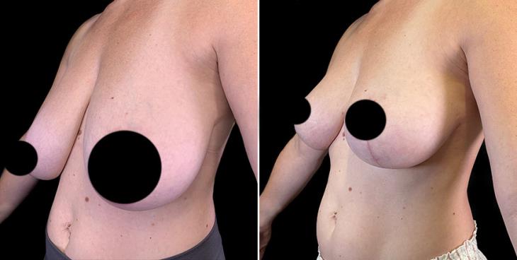 Breast Lifting Surgery Results ¾ View