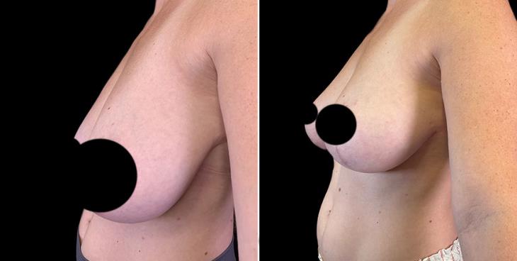 Breast Lifting Surgery Results Side View