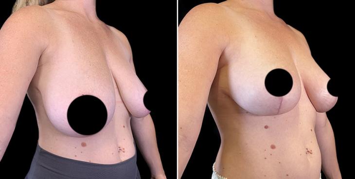 ¾ View Breast Lifting Surgery Results