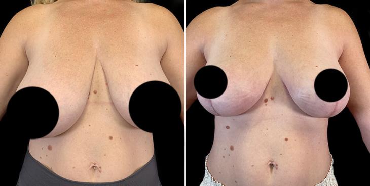 Breast Lifting Surgery Results