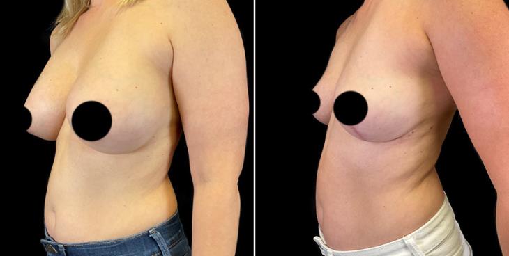 Surgery To Lift Breasts Results ¾ View
