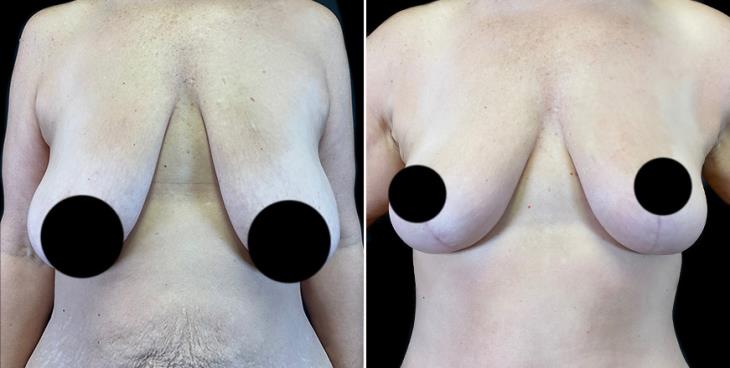 Results Of Surgical Breast Lift Close-Up