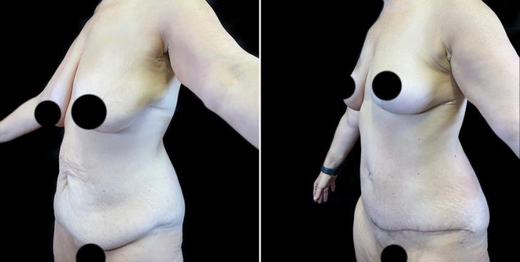 Results Of Surgical Breast Lift ¾ View