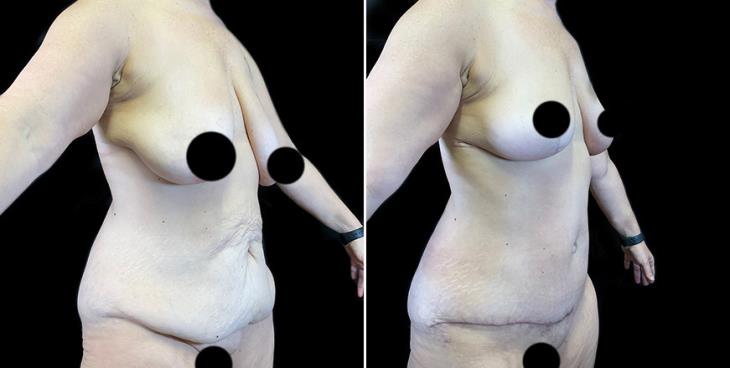 ¾ View Results Of Surgical Breast Lift