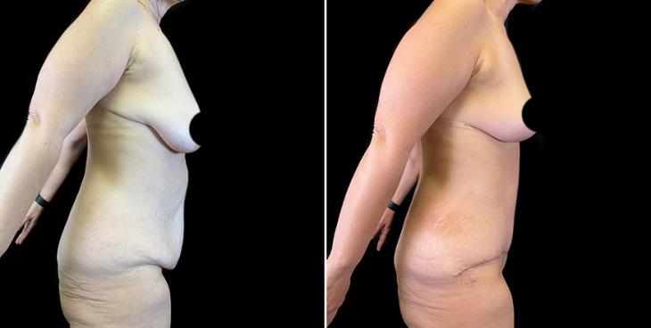 Side View Results Of Surgical Breast Lift