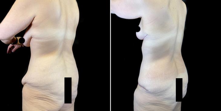 Results Of Surgical Breast Lift Side View