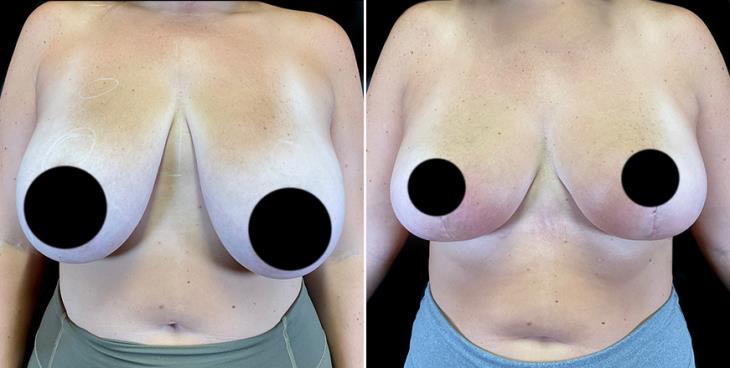 Surgical Breast Reduction Results