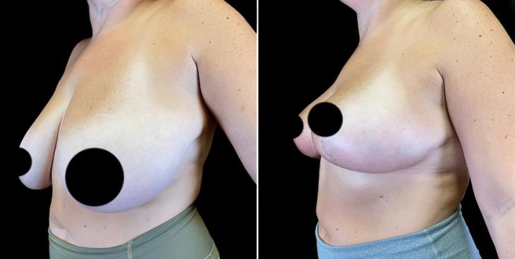 Surgical Breast Reduction Results ¾ View