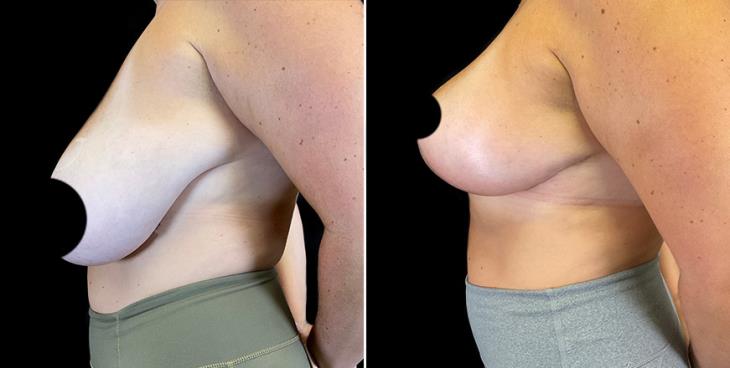 Surgical Breast Reduction Results Side View