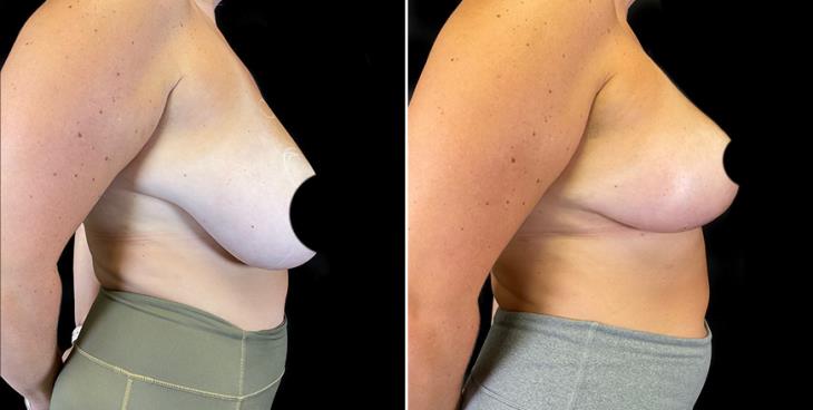 Side View Surgical Breast Reduction Results