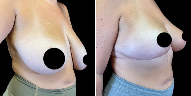 3/4 View Surgical Breast Reduction Results