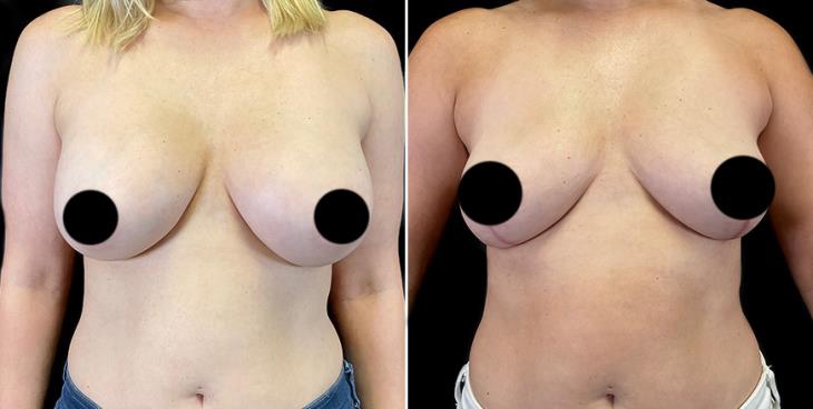 Breast Implant Removal Results