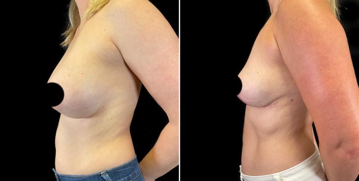Breast Implant Removal Results Side View