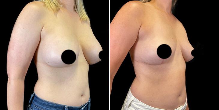 ¾ View Breast Implant Removal Results
