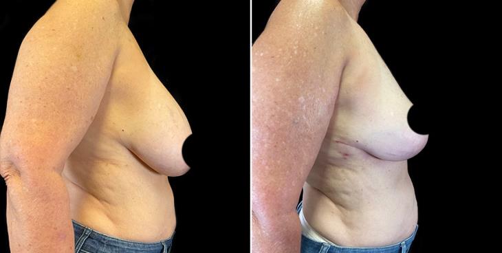Side Profile Breast Implant Removal Results