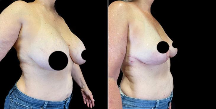 Breast Implant Removal Result ¾ View