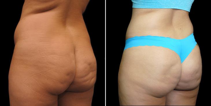 Lipo 360 Results ¾ Back View