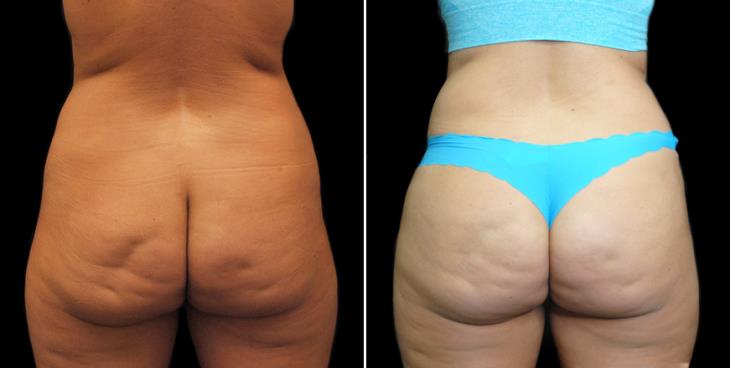 Lipo 360 Results Back View