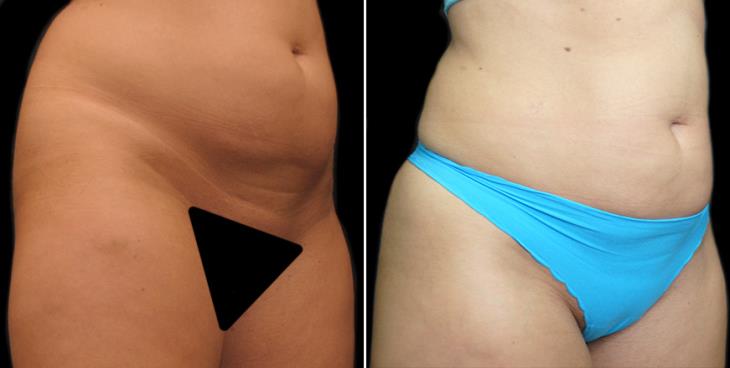 ¾ View Lipo 360 Results