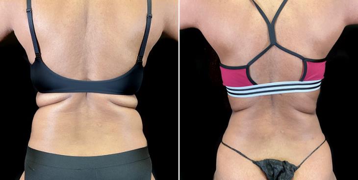 Lipo 360 Results Back View Atlanta