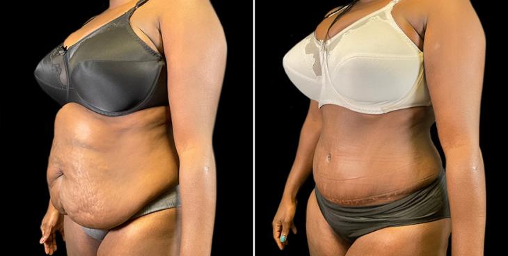 Lipo 360 Results Georgia