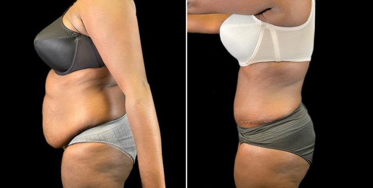 Side View Georgia Lipo 360 Results