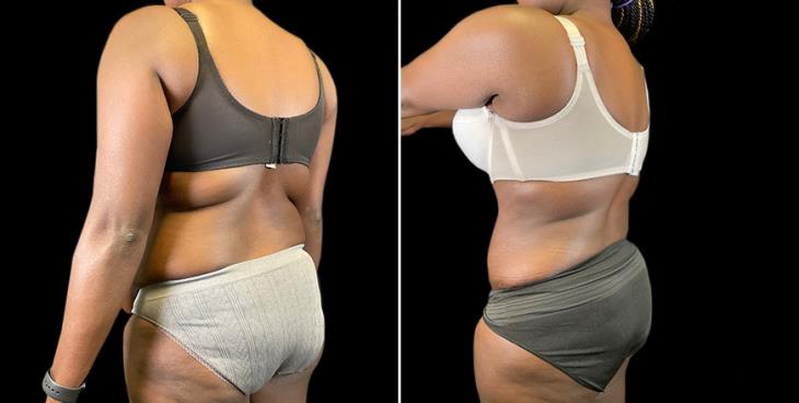 Results Of Lipo 360 GA
