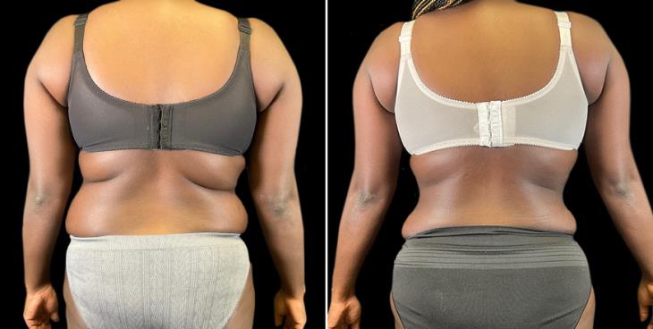 GA Lipo 360 Results