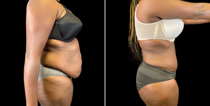Georgia Lipo 360 Results Side View