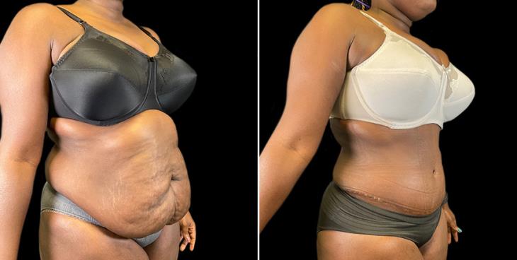 Georgia Lipo 360 Results