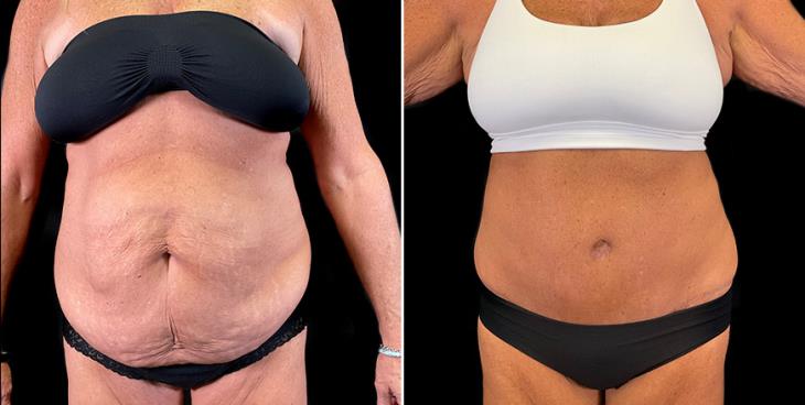 Before & After Stomach Tuck Surgery Front View