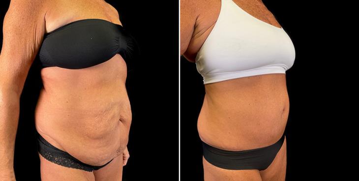 Before & After Stomach Tuck Surgery ¾ View