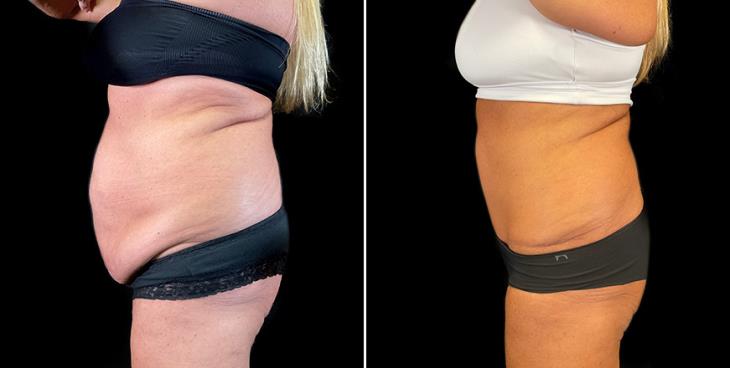 Before & After Stomach Tuck Surgery Side View