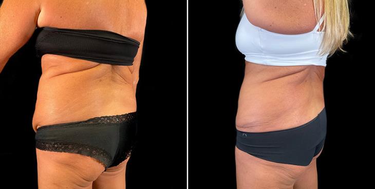 Before & After Stomach Tuck Surgery