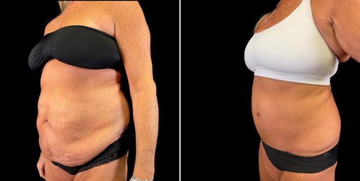¾ View Before & After Stomach Tuck Surgery