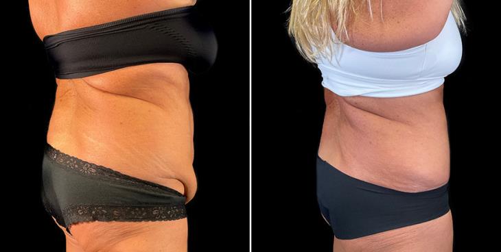 Before & After Stomach Tuck Surgery ¾ Back View