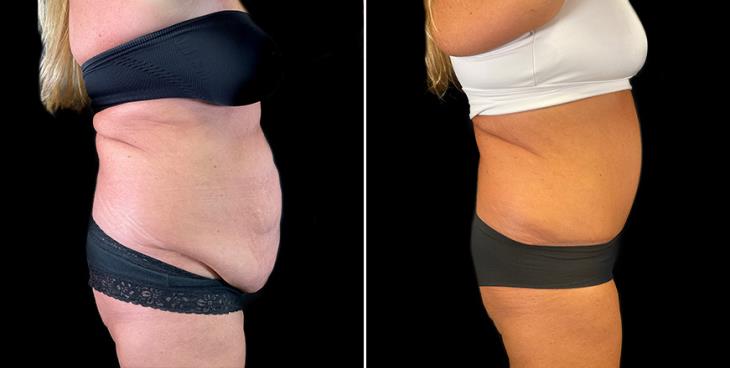 Atlanta Georgia Abdominoplasty Results Side View