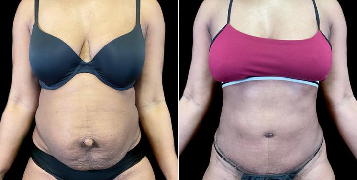 Before And After Stomach Tuck Surgery Front View