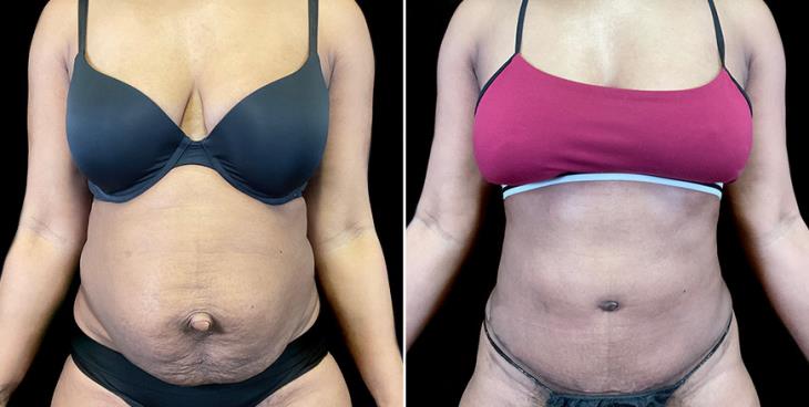 Abdominoplasty Results In Atlanta GA