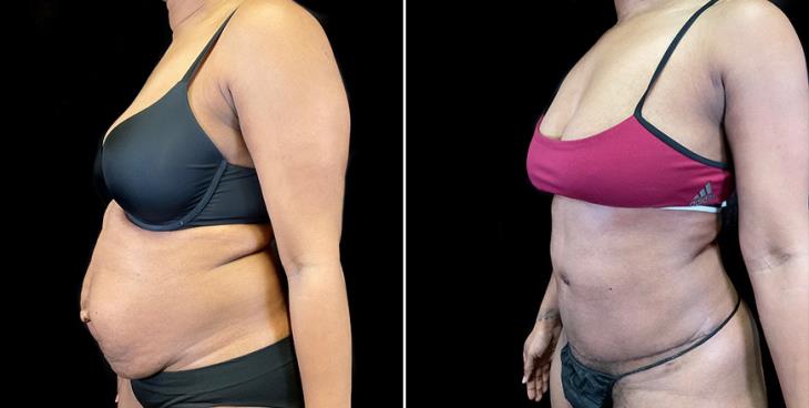 Before And After Stomach Tuck Surgery ¾ View