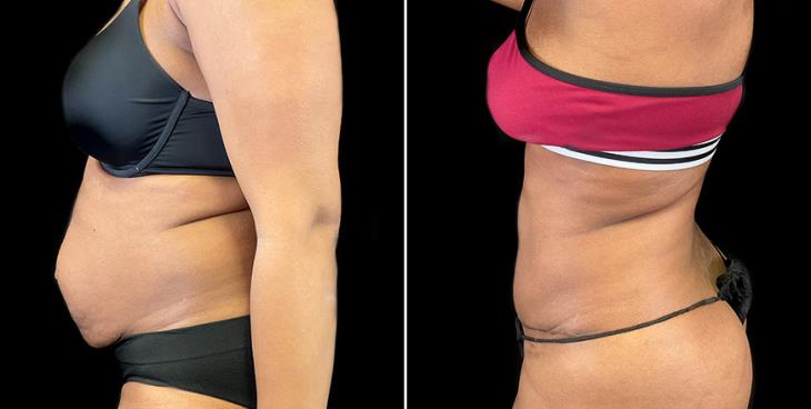 Before And After Stomach Tuck Surgery Side View