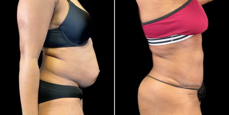 Abdominoplasty Results In Atlanta GA Side View