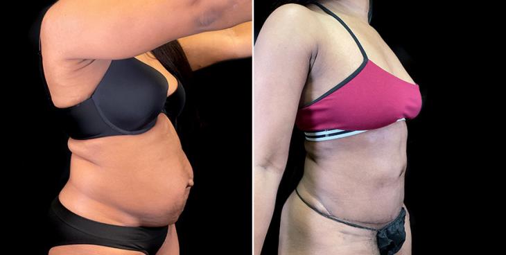 Abdominoplasty Results In Atlanta GA ¾ Right View