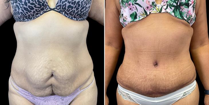 Before & After Stomach Tuck Surgery Atlanta