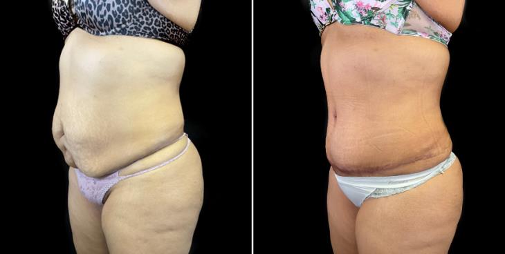 Before & After Stomach Tuck Surgery Atlanta ¾ View